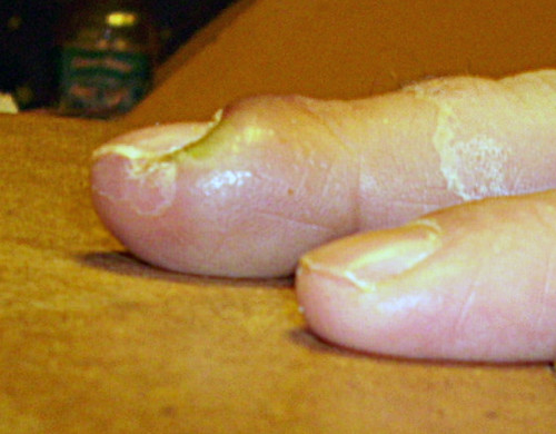 lump under big toe - MedHelp