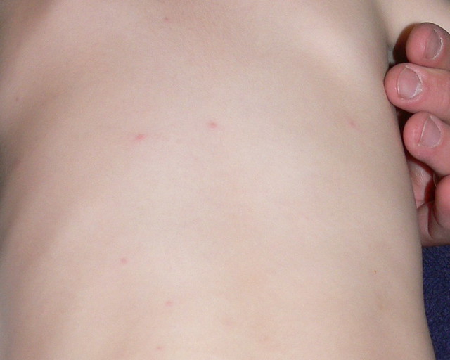 Chicken Pox - Home-Remedies-For-You
