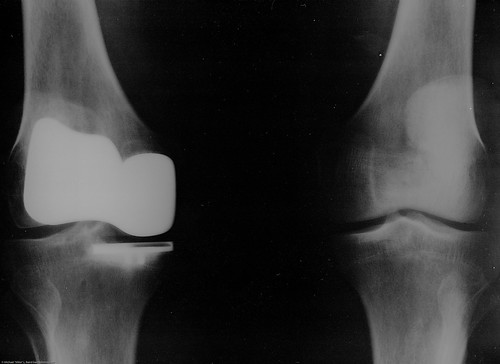 Smith & Nephew Journey Deuce Bi-compartmental unit) 3 of 3 Michael L. Baird's right knee as shown in x-ray 11 June 2008