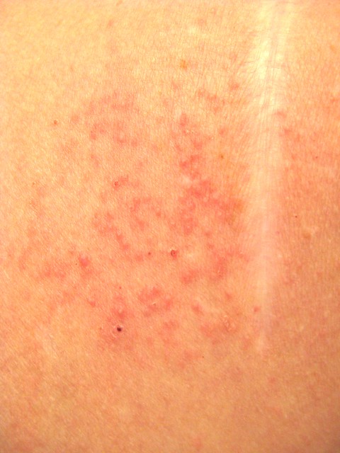 Rash On My Shoulder From The Sleep Apnea Study Connectors Flickr