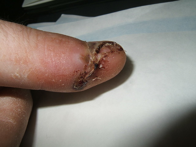 After an operation to repair the nail bed and remove part of the thumb nail