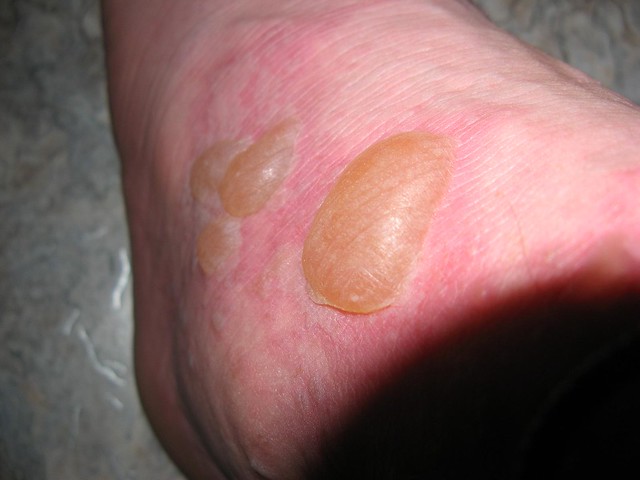 blisters-from-allergic-reaction-flickr-photo-sharing