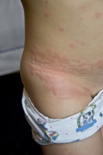 Brooke rash bug bite-March 30, 2008 | Flickr - Photo Sharing!
