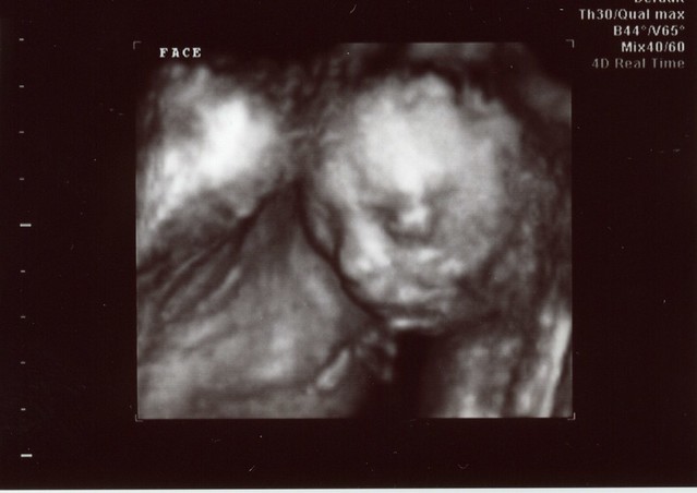 Baby boy at 20 weeks. Cool 3D ultrasound thingie from the doctor's.