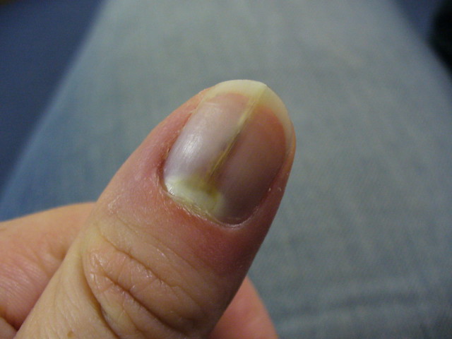 beginning shot of my thumb nail. This was when it was still very sore at the