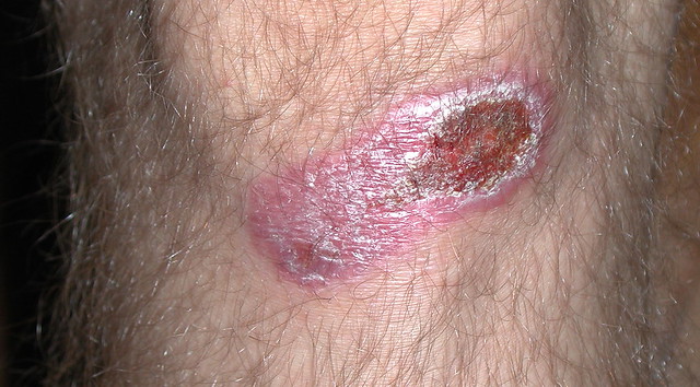 Secondary Scab