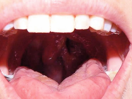 Holes In Throat 121