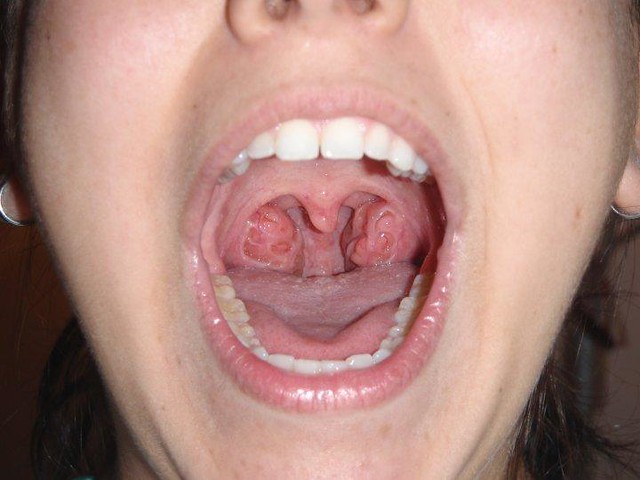 my-tonsils-flickr-photo-sharing