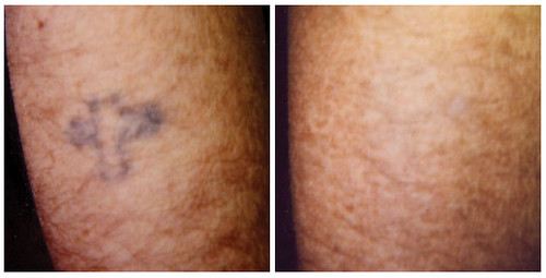 Patients at South Coast MedSpa have acheived amazing laser tattoo removal