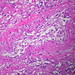 Adipose tissue embolus  Case 104