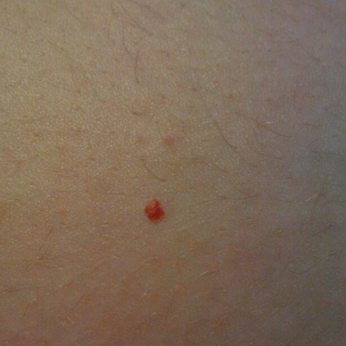 red moles on body
