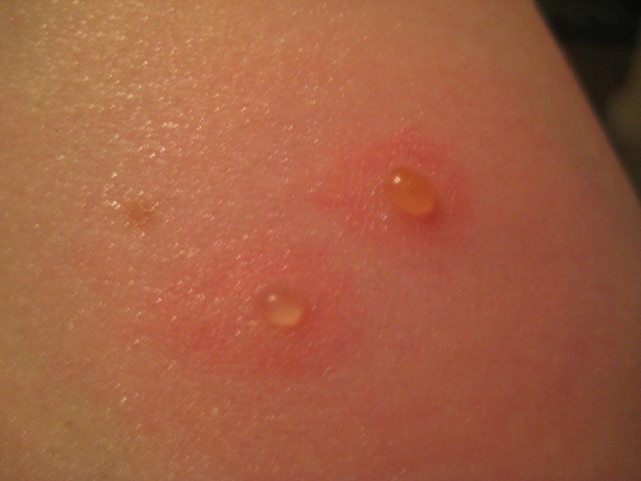 Insect Bites - Pictures, Blister, Infection, Identification