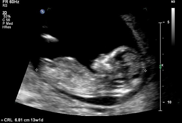13-week-ultrasound-flickr-photo-sharing