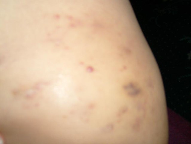 Picture of Skin Diseases and Problems – Hidradenitis ...