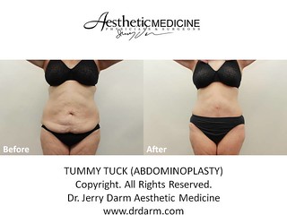 Dr. Darm, Tummy Tuck Before and After - RT Slide1