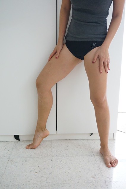 REVIEW Coolsculpting by Clique Clinic - Before and after pictures of Rebecca Saw-002
