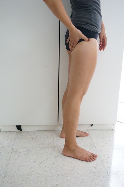 REVIEW Coolsculpting by Clique Clinic - Before and after pictures of Rebecca Saw-003