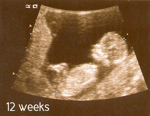 ultrasound week 12.jpg