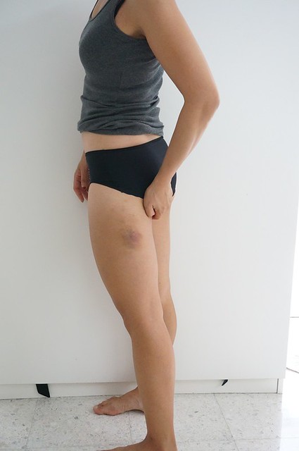 REVIEW Coolsculpting by Clique Clinic - Before and after pictures of Rebecca Saw