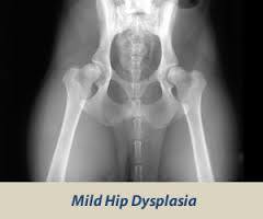 Mild Hip dysplasia