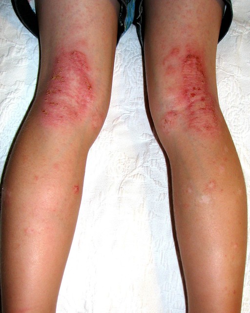 List 100+ Images dry skin on knees pictures Sharp