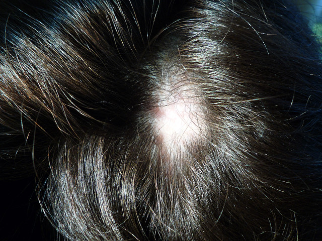 Alopezia areata