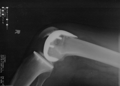 Smith & Nephew Journey Deuce Bi-compartmental unit) 2 of 3 Michael L. Baird's right knee as shown in x-ray 11 June 2008