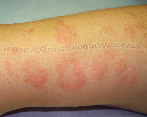 Pityriasis rosea (Christmas tree rash): Causes, Treatment ...