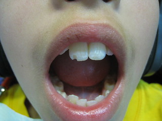 Chipped Tooth