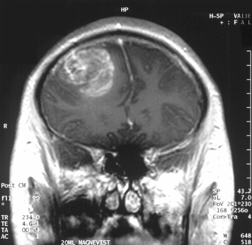 MRI scan of patient with a glioblastoma brain cancer tumor.