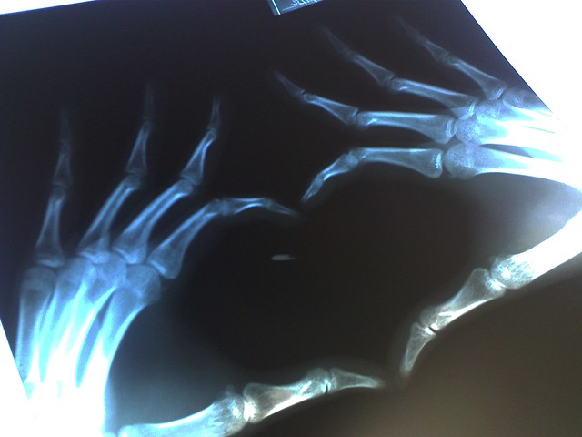 Heart Shape X-Ray (Film Both Hands) /เอ็กซเรย์รูปหัวใจ