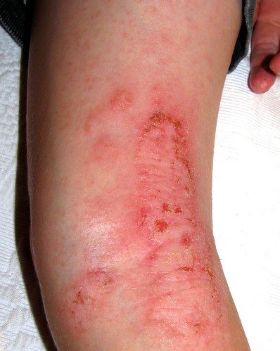 Eczema behind knee
