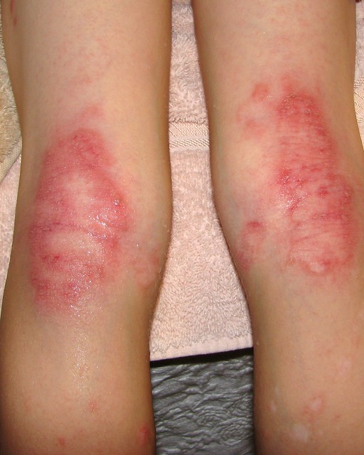 eczema legs #10