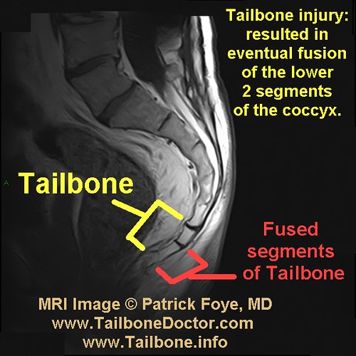 dislocated tailbone