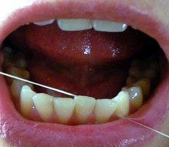 Periodontal Disease - Oral bacteria - Flossing