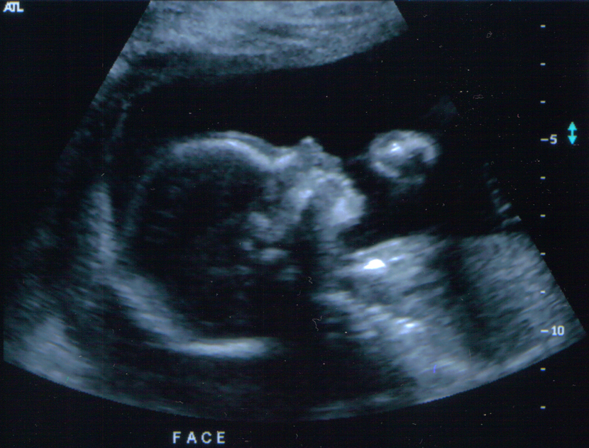 Isabelle Ultrasound