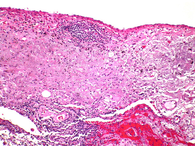 Apical cap/scar | Apical, subpleural fibroelastic scar with … | Flickr ...