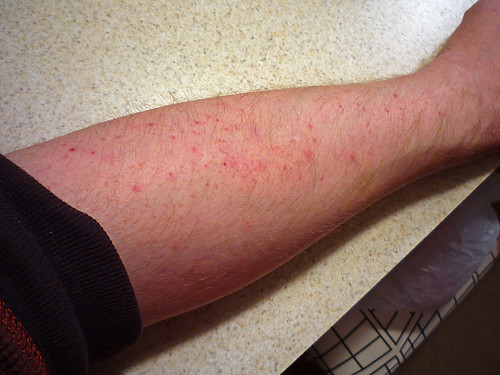 Adult Skin Rash: Common Causes and Natural Treatments