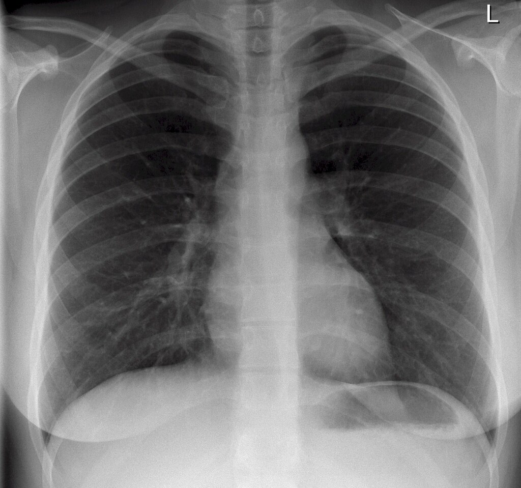 Normal Chest X Ray A Photo On Flickriver Sexiezpix Web Porn