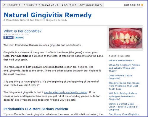 Gingivitis Treatment