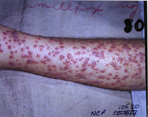 Smallpox photo