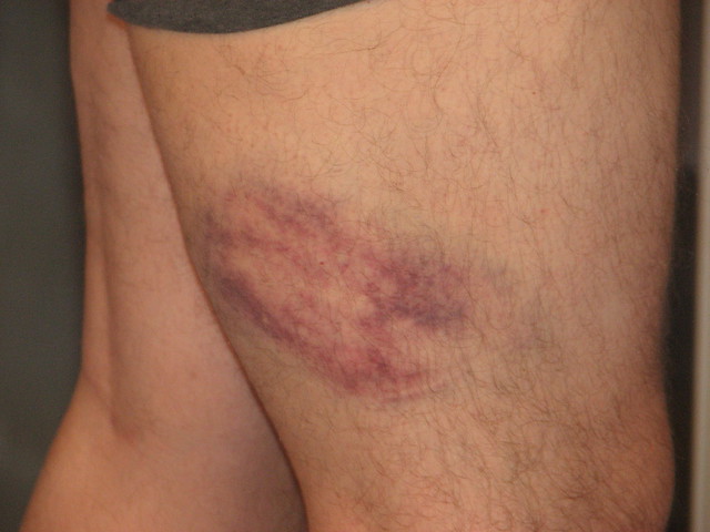 Leg Bruise 