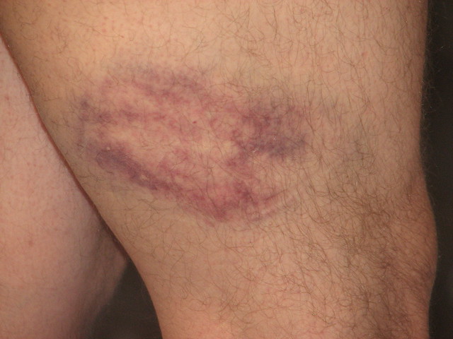 Leg Bruise 