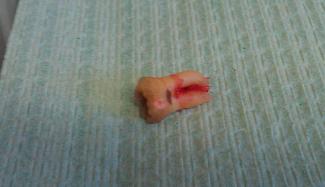 The tooth I just had out