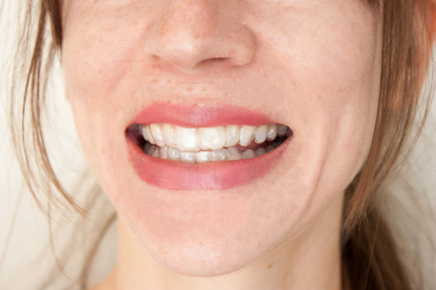 Smile Brilliant Teeth Whitening Trays