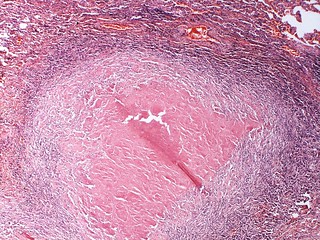 Photo:Syphilitic gumma  Case 278 By:Pulmonary Pathology