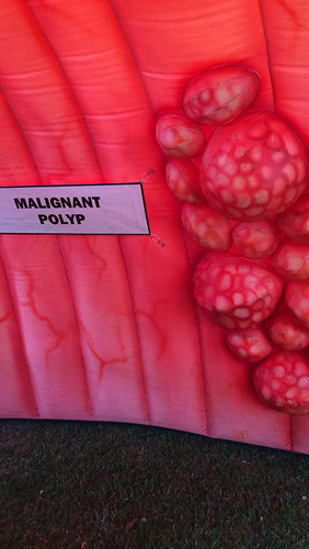 Malignant Polyp