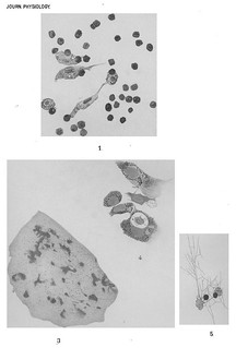 Plate XXXI, Journal of Physiology 10 (6) (1889). Figs. 1-5 from C.A. Ballance and C.S. Sherrington, 'On Formation of Scar-Tissue'.