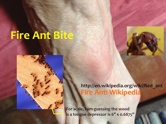 Fire Ant Bite | Flickr - Photo Sharing!