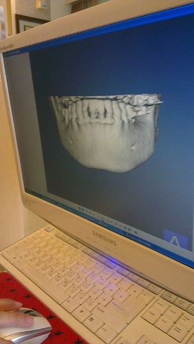 豐美牙醫診所 PRF 3D斷層植牙 (3)